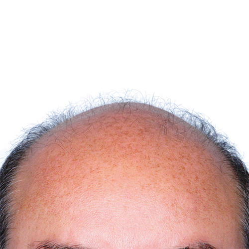 Balding