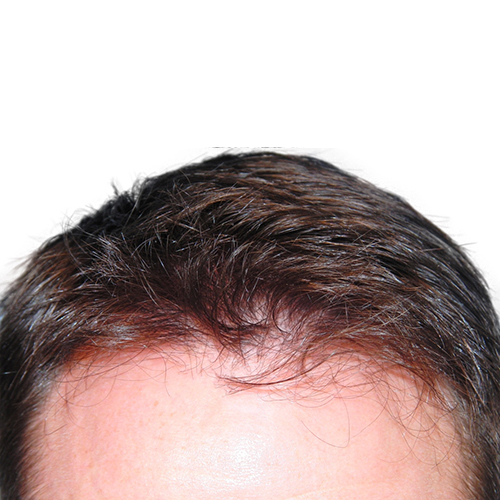 Restored hairline