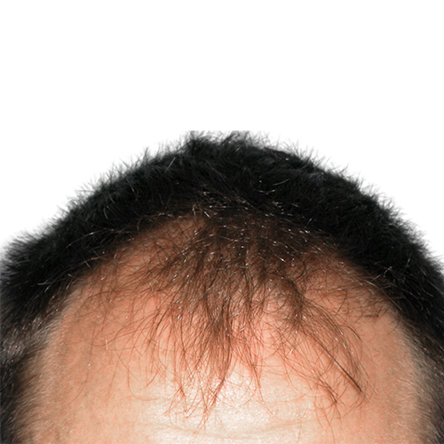 Pattern hair loss