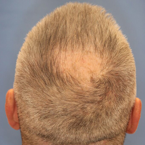 Bald spot