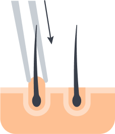 Implanting the follicles