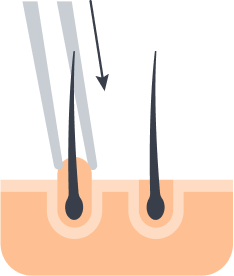 Follicle implantation