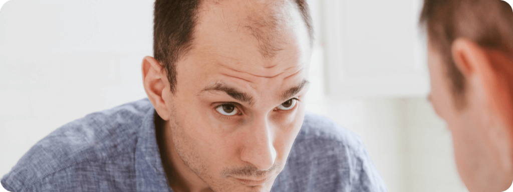 Standard male pattern hair loss