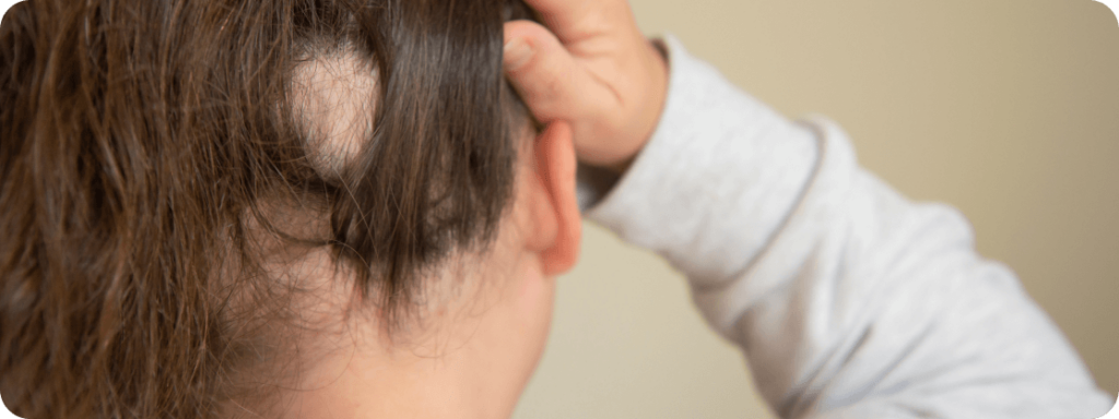 Patchy hair loss