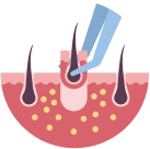 Follicle extraction
