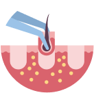 Follicle implantation