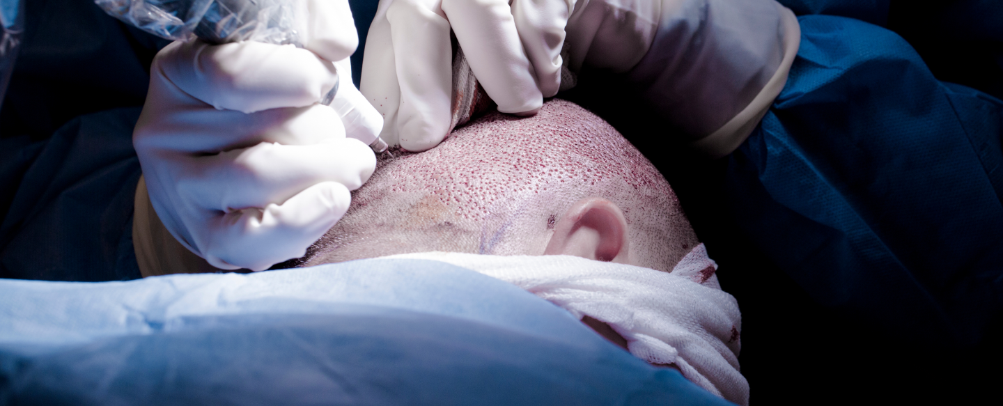 Corrective Hair Transplants