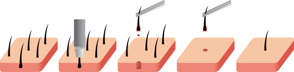 hair transplant layer