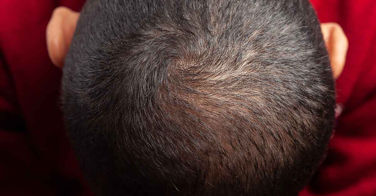 Types of Hair Loss