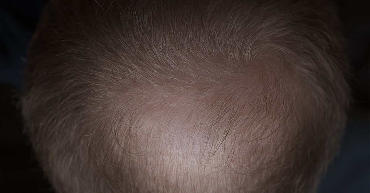 What is Androgenic Alopecia?