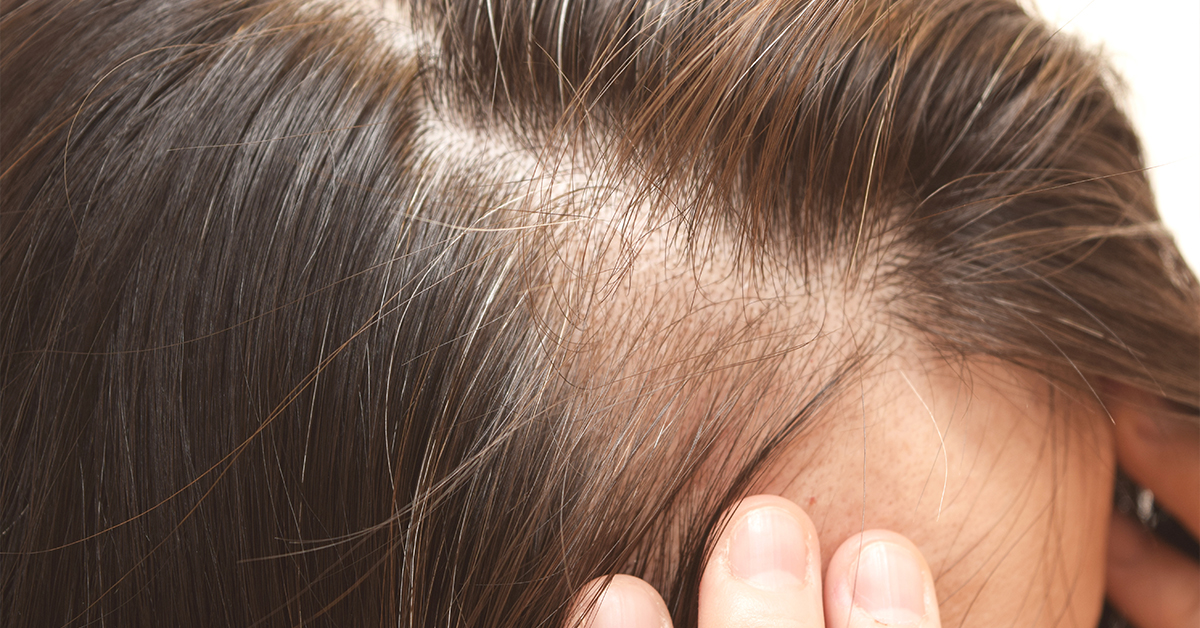 What Is Telogen Effluvium?