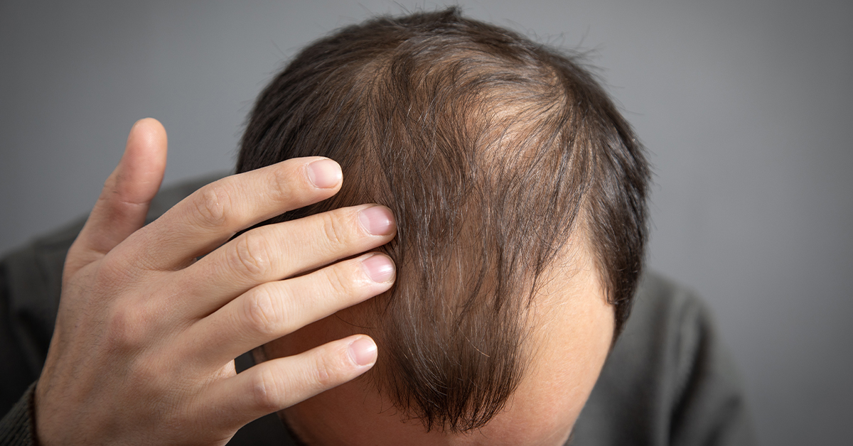 What Is Anagen Effluvium?