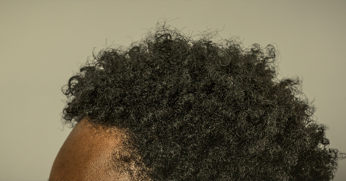 Ethnic Hair Loss Patterns